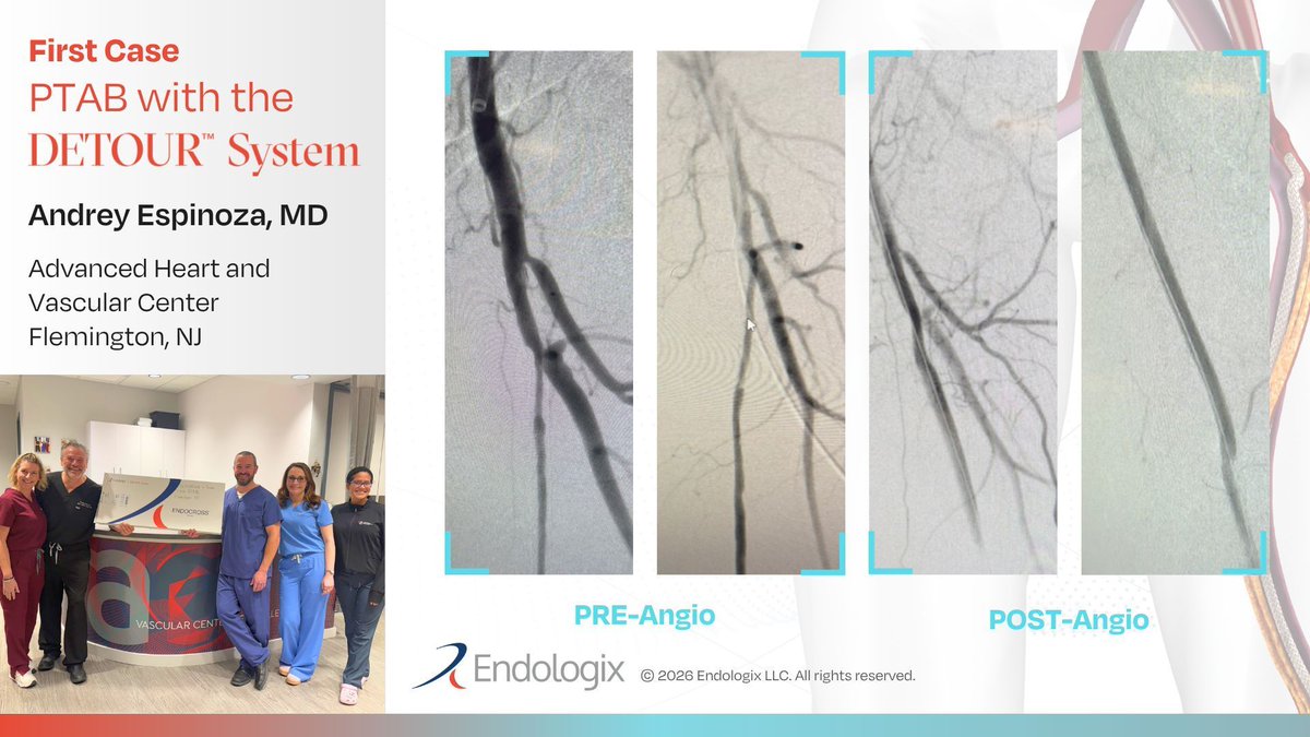 endologix's tweet photo. A great first #PTAB case for Dr. Andrey Espinoza at Advanced Heart and Vascular Institute of Hunterdon - and a great case for teamwork in managing a highly complex revascularization.
 
A 75-year-old female with a history of five prior lower-extremity interventions presented with a dorsal foot wound secondary to advanced critical limb ischemia (#CLI). Given the complexity of her femoropopliteal disease and extensive prior treatment history, she underwent an #endovascular bypass using PTAB with the #DETOURSystem, successfully traversing previously placed stents and heavily calcified segments. 

Learn about the DETOUR System here: https://t.co/ycFuGmcK9i

#PeripheralArteryDisease #medtech #healthcareinnovation #medtwitter #cardiotwitter #endovascularinnovation #medicalinnovation #percutaneous
