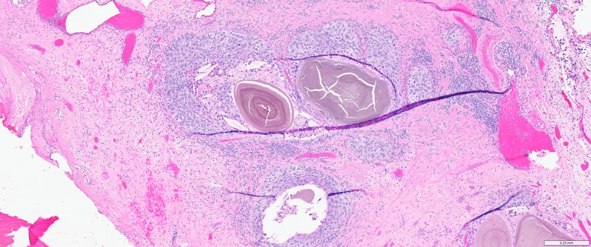 slusagar's tweet photo. #GUpath TURP
prostatic intraductal carcinoma (IDC-P)?
NOPE! this is urothelial carcinoma in situ colonizing prostatic urethral mucosa🚨
⏬#IHCpath⏬ https://t.co/d3CZvEgXJY
