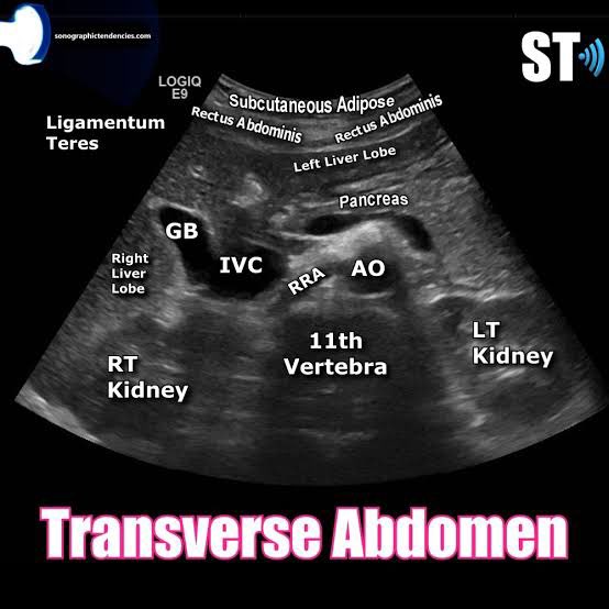 Transverse Upper Abdominal Ultrasound Anatomy!!!

This transverse upper abdominal ultrasound image demonstrates a classic anatomical window that is essential for orientation in abdominal and POCUS examinations. Clearly visualized are the aorta and inferior vena cava, serving as