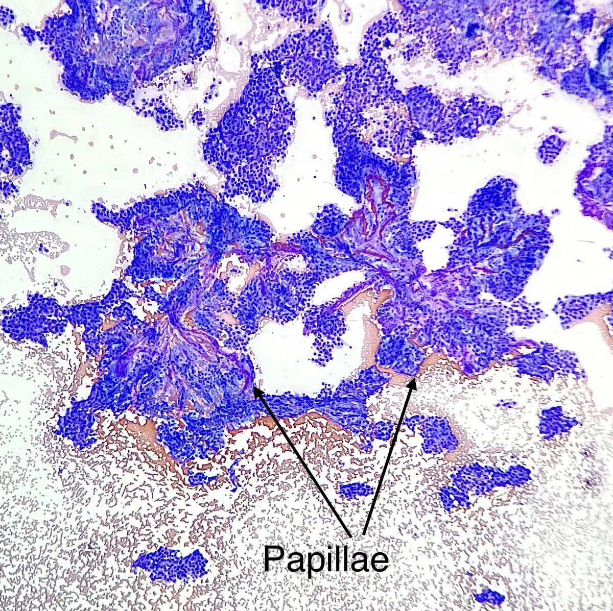 Nate_path's tweet image. Grooves, inclusions and papillae. A classic example of PTC #PathX #Cytopath #Thyroid