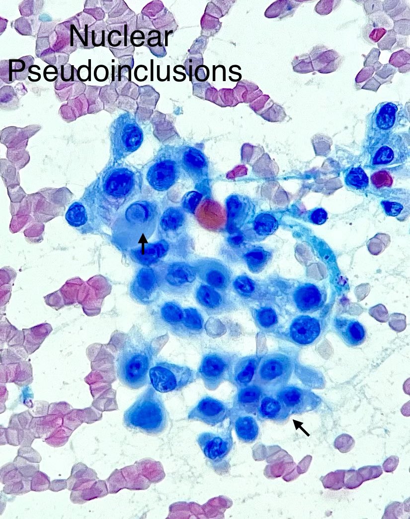 Nate_path's tweet image. Grooves, inclusions and papillae. A classic example of PTC #PathX #Cytopath #Thyroid