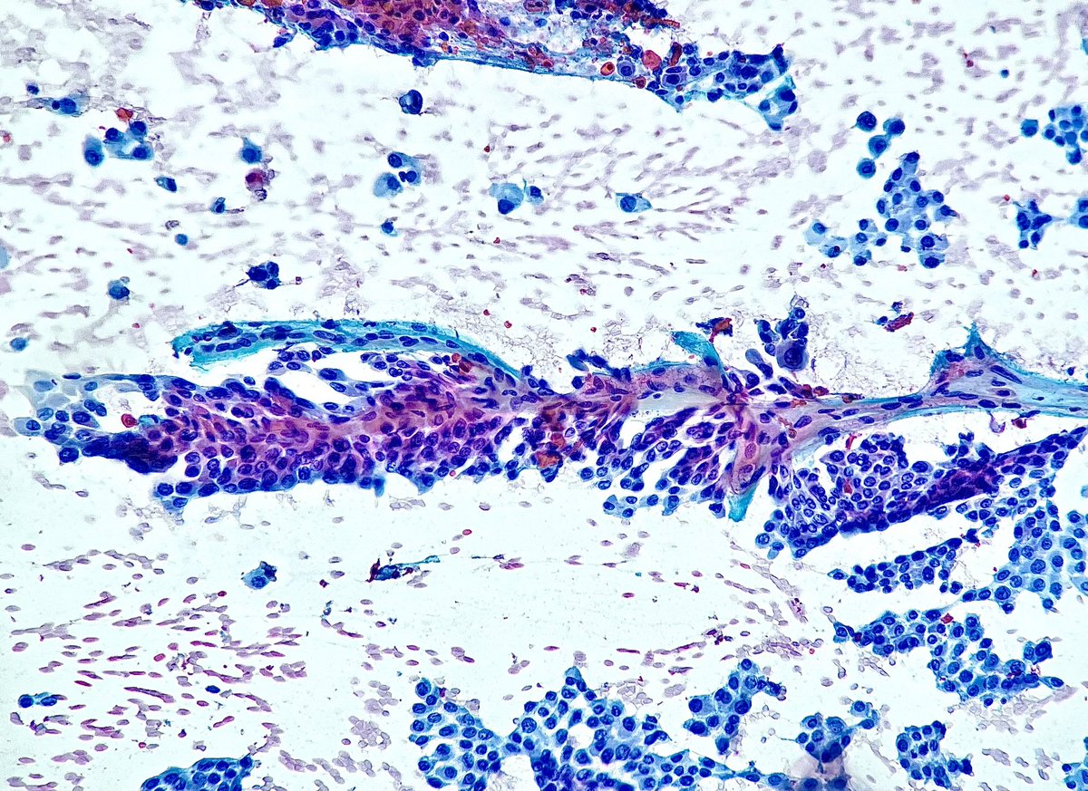 Nate_path's tweet image. Grooves, inclusions and papillae. A classic example of PTC #PathX #Cytopath #Thyroid