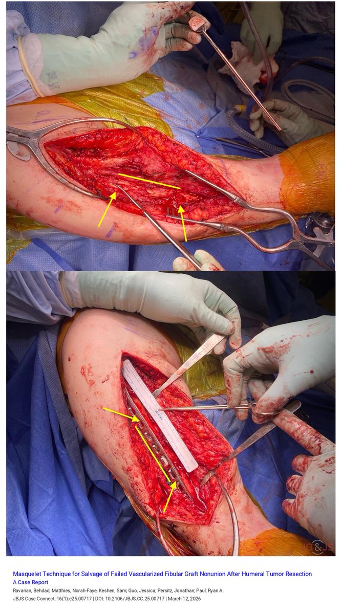 jbjs's tweet image. "Masquelet Technique for Salvage of Failed Vascularized Fibular Graft Nonunion After Humeral Tumor Resection: A Case Report" by Ravarian et al. 

Read the full article 👉 bit.ly/4bCGt3X

#shoulderandelbow #trauma