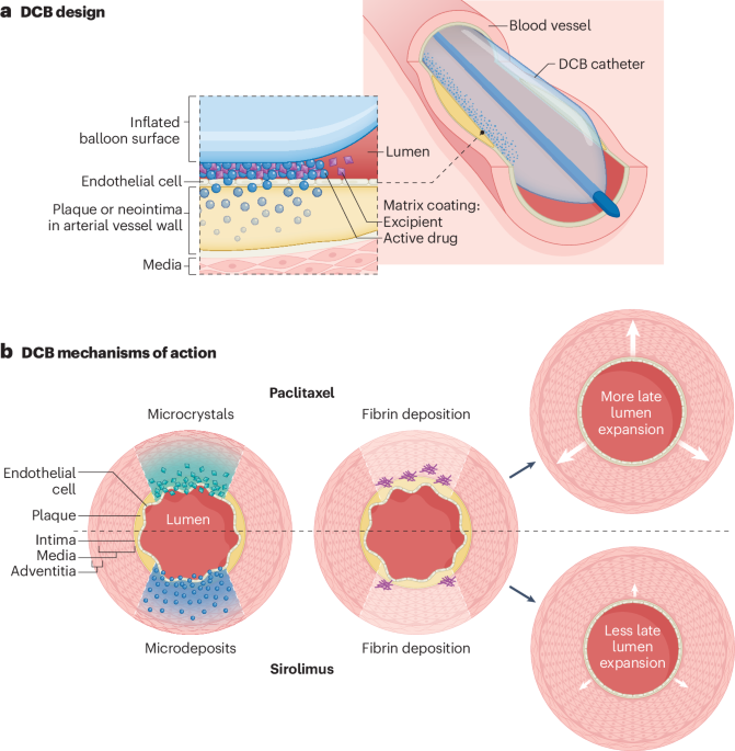 NatRevCardiol's tweet photo. New online!  Drug-coated balloon angioplasty for coronary and peripheral artery disease: latest evidence and clinical indications https://t.co/4TyqGr7viw https://t.co/OuJ8Zo1qZZ