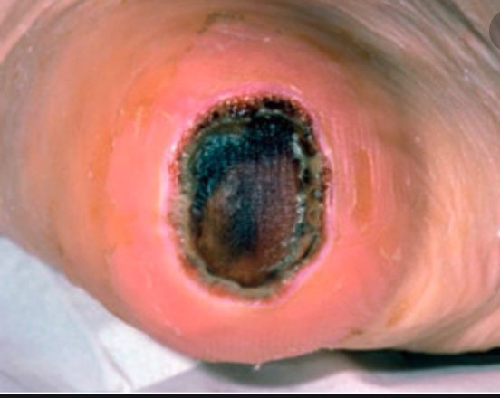 DGArmstrong's tweet photo. 6.3 fold greater risk for mortality in people presenting with heel ulcers vs. forefoot ulcers – DF Blog https://t.co/palSV7XXEI https://t.co/6d28gnyAMc https://t.co/cAFvInIp1I