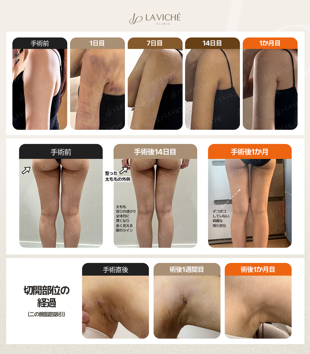 ラビチェ医院【脂肪吸引・脂肪吸入・脂肪移植・豊胸・脂肪豊胸・二重顎・二の腕・腹部・太もも・全身】 tweet media