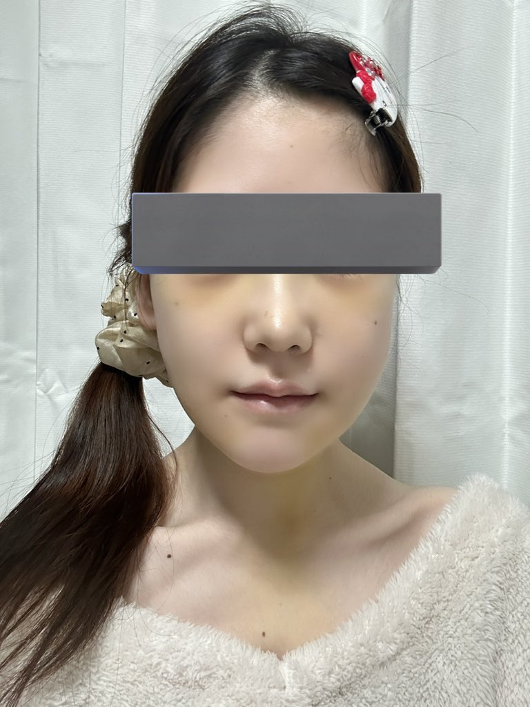 🩶 輪郭3点＋鼻フル(再)、額挙上、自然癒着目つき矯正dt tweet media