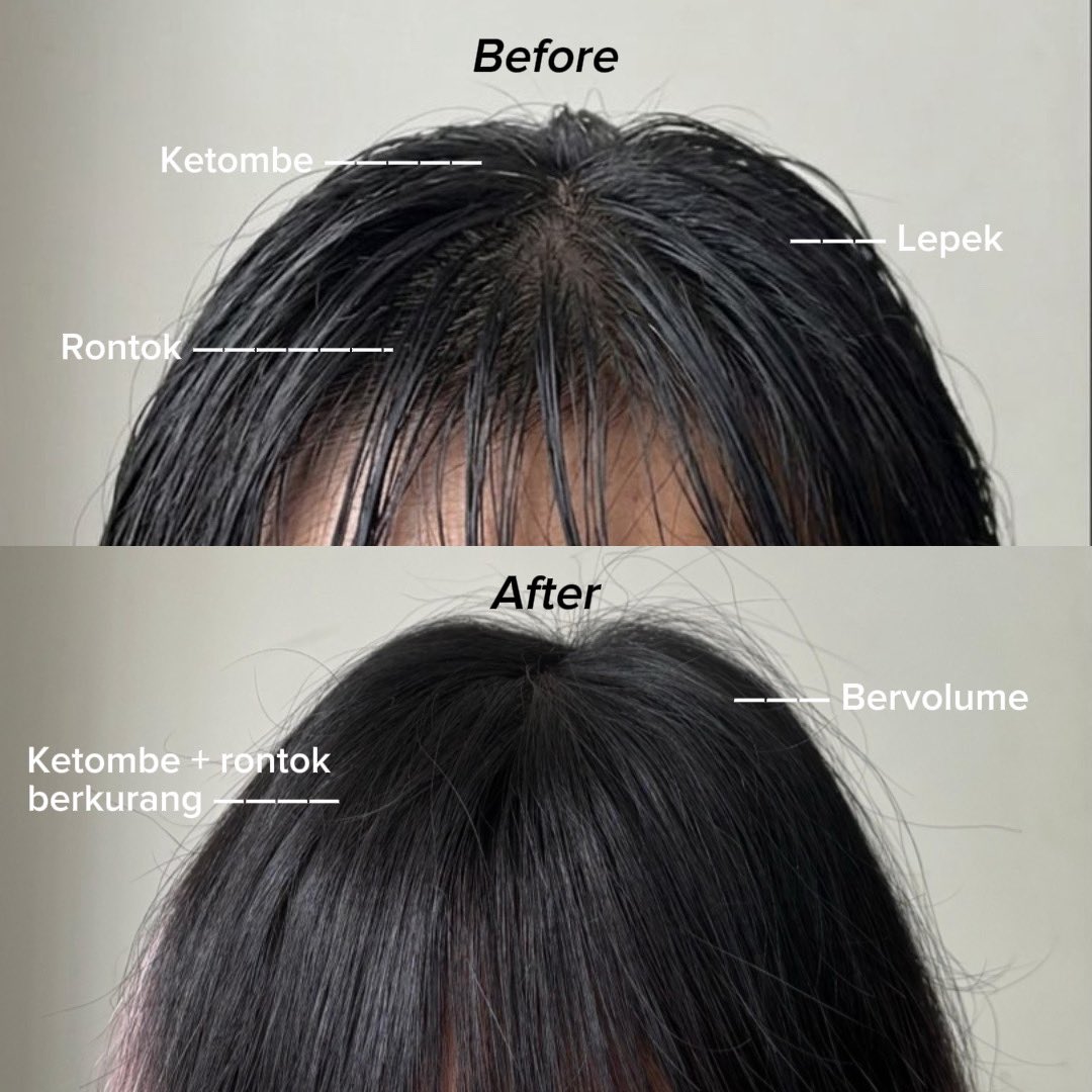 msbb_id's tweet photo. Di umur berapa kamu tau kalo...

Rambut lepek = pilih aloe vera, panthenol
Ketombe / gatal = salicylic acid / kemiri / peppermint
Rambut kering, gampang patah = hair oil
Rusak sering styling = conditioner / hair mask

Save thread ini Minperi mau bagi2 solusinya sekalian 👇🏻👇🏻👇🏻 https://t.co/wLOp8IZEWR