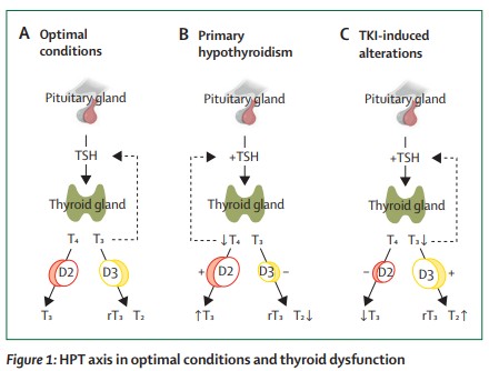TheLancetEndo's tweet image. Tyrosine kinase inhibitor (TKI)-induced thyroid hormone abnormalities result from interference with the #HPT axis and peripheral #thyroid #hormone metabolism regulators thelancet.com/journals/landi…
#hypothyroidism #TKIs