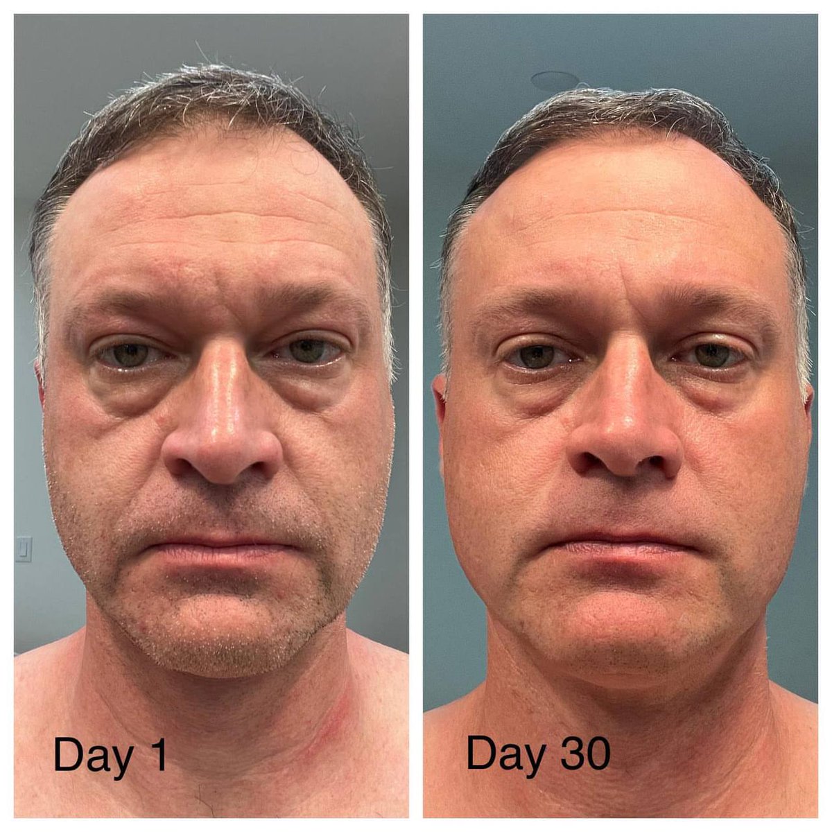 Peptide_Store's tweet image. Proof in the peptides. 👇
✅ Firmer skin
✅ Reduced puffiness
✅ Healthier glow

This is activated collagen working at the cellular level, not your average supplement.

Want to try it? Drop a 💧 or tap the link in my bio!

#LiquidCollagen #BeforeAndAfter #SkinHealth #LifeVantage