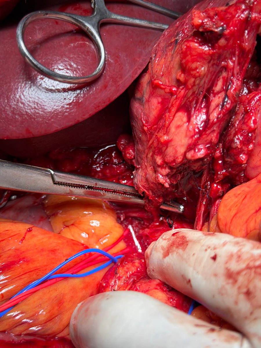 PrabinBikramTh2's tweet photo. LGV, SV ,IMV, ICV, JV,PV and SMV 
SMA, IPDA from Aberrant rt HA
@IHPBA @APHPBA @dhireshmaharjan @TeamSurgery247 https://t.co/hvXpRAqG0K