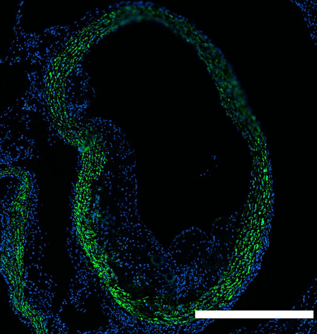 jclinicalinvest's tweet image. ADAMTS7 has been repeatedly associated with #coronary artery disease. 

doi.org/10.1172/JCI187…
In this Research Article, Robert C. Bauer @RobertCBauer &amp;amp; team @ColumbiaMed use the largest human #atherosclerosis carotid artery scRNA-seq dataset and new mouse models to demonstrate