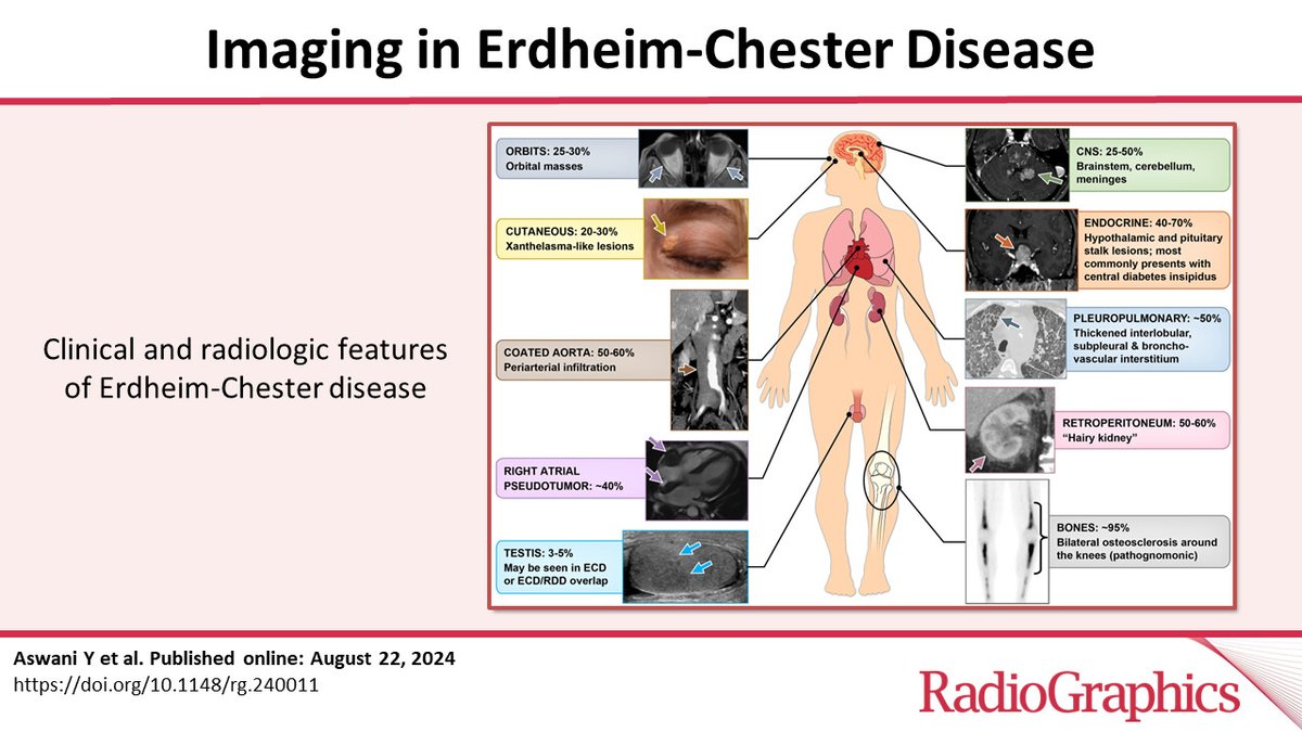 Erdheim–Chester disease...Imaging.