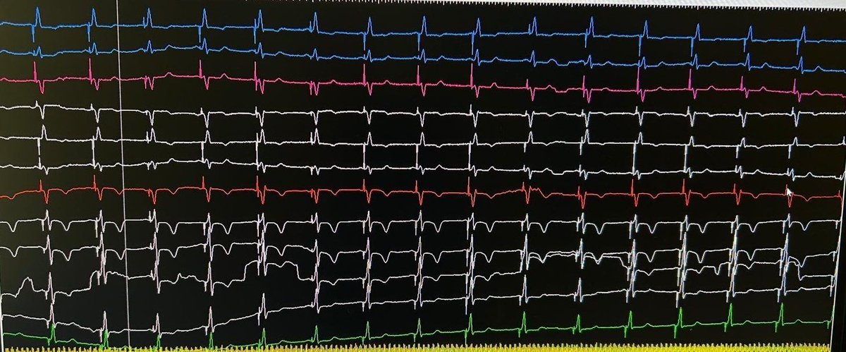 Arritmias Hospital Dr. Negrín ⚡ tweet media