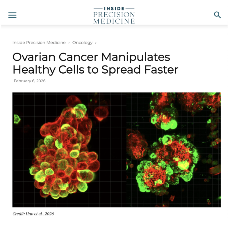 drconnealymd's tweet photo. In a recent study published in Science Advances, researchers found that ovarian cancer cells recruit healthy mesothelial cells lining the abdomen and form small groups that move through tissue together, making them harder to treat and more likely to spread.

◽️Tumor cells release signals (like TGF-β)
◽️Mesothelial cells lose their tight connections and barrier function
◽️These cells become more mobile and change shape
◽️The tissue is remodeled, creating openings
◽️Cancer cells move through these openings alongside them
◽️Traveling as a group makes them more resistant to chemotherapy