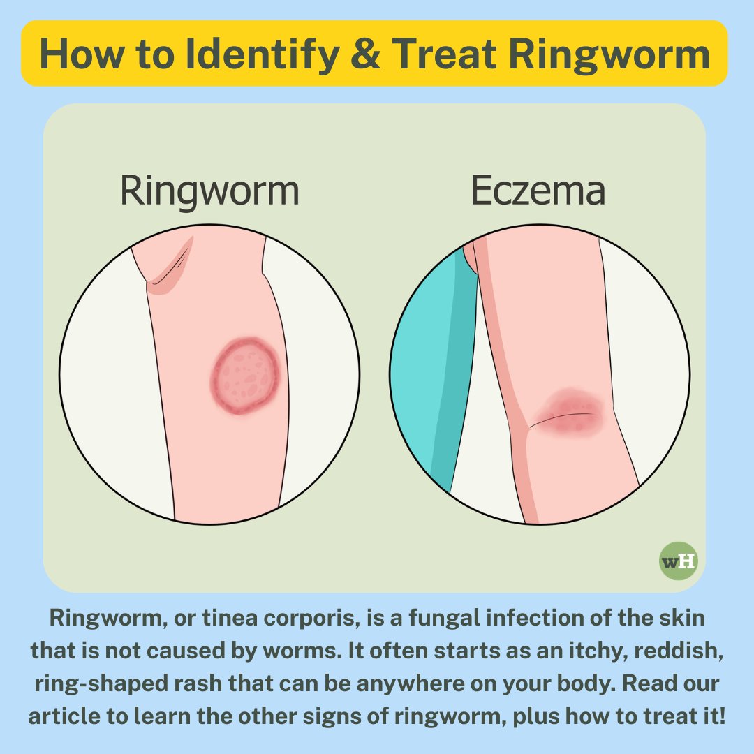 wikiHow's tweet image. Don’t let a rash slow you down! 🛑 Learn how to spot the signs of ringworm and treat it quickly with these expert tips. Full article here: wikihow.com/Identify-and-T…

 #wikihow #healthtips #skincare