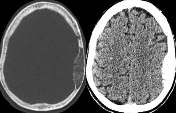 daniel_gewolb's tweet image. ⭐️ What is the most likely diagnosis in this 80 y/o F found to have this incidental lesion on MRI? Lesion has been present without significant change for  at least 8 years.

#medicine #Neurology #Neuroradiology #ENT #radres #futureradres #MRI #FOAMed @Radiopaedia @ASHNRSociety