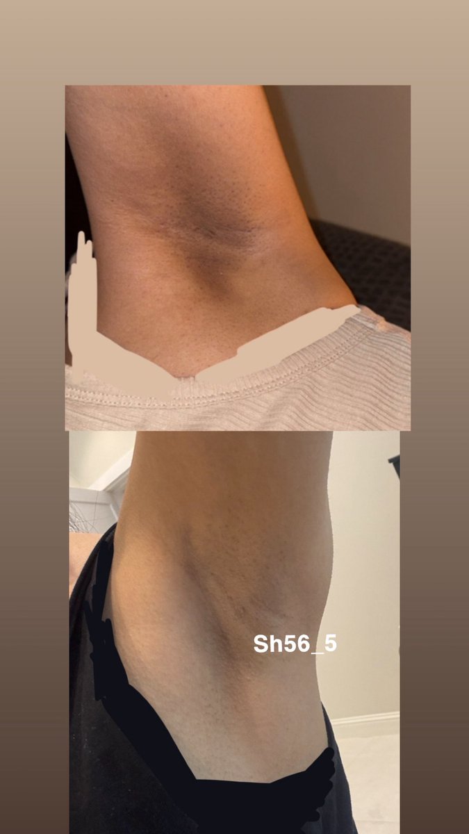 sh56_5's tweet photo. بنات بذكر لكم بثريد تجربتي بتصبغات الاندر ارم 
بس كل اللي ابيه اي وحده تستفيد تدعي لي بظهر الغيب 
طيب لو تلاحظون عندي تصبغ يعتبر متوسط مو قوي بس يضايق وبسبته ما كنت اقدر البس اي شي مفتوح من الاكتاف 
طيب ايش الاشياء اللي ساعدتني اوصل لنتيجه قريبه من ال٨٠ بالميه https://t.co/5t56Z6ZKBM