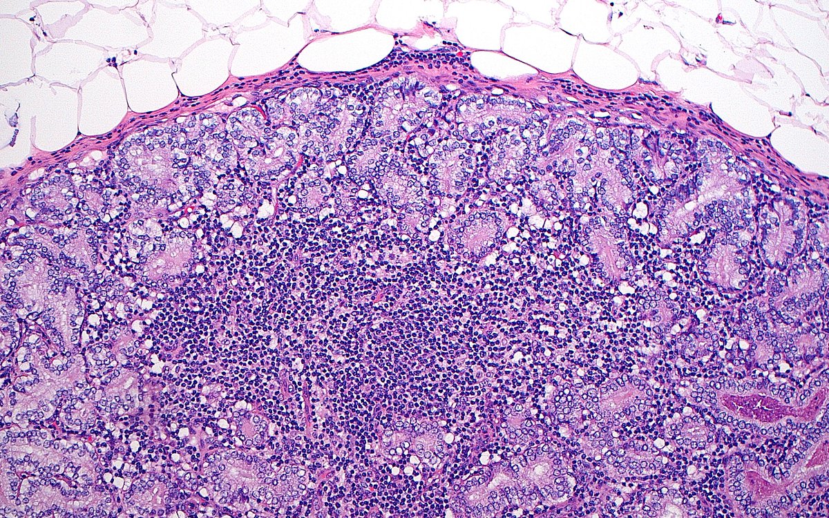 ziad_zaatari's tweet image. 🔬📷 Metastatic Prostate Cancer in a Lymph Node ~ #GUpath #Pathology #Histology #PathArt