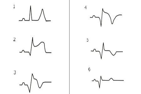 Mein Portfolio und ein Herzinfarkt Herz-EKG* beim Blick auf selbiges ähneln sich seit Trump Präsident ist

*