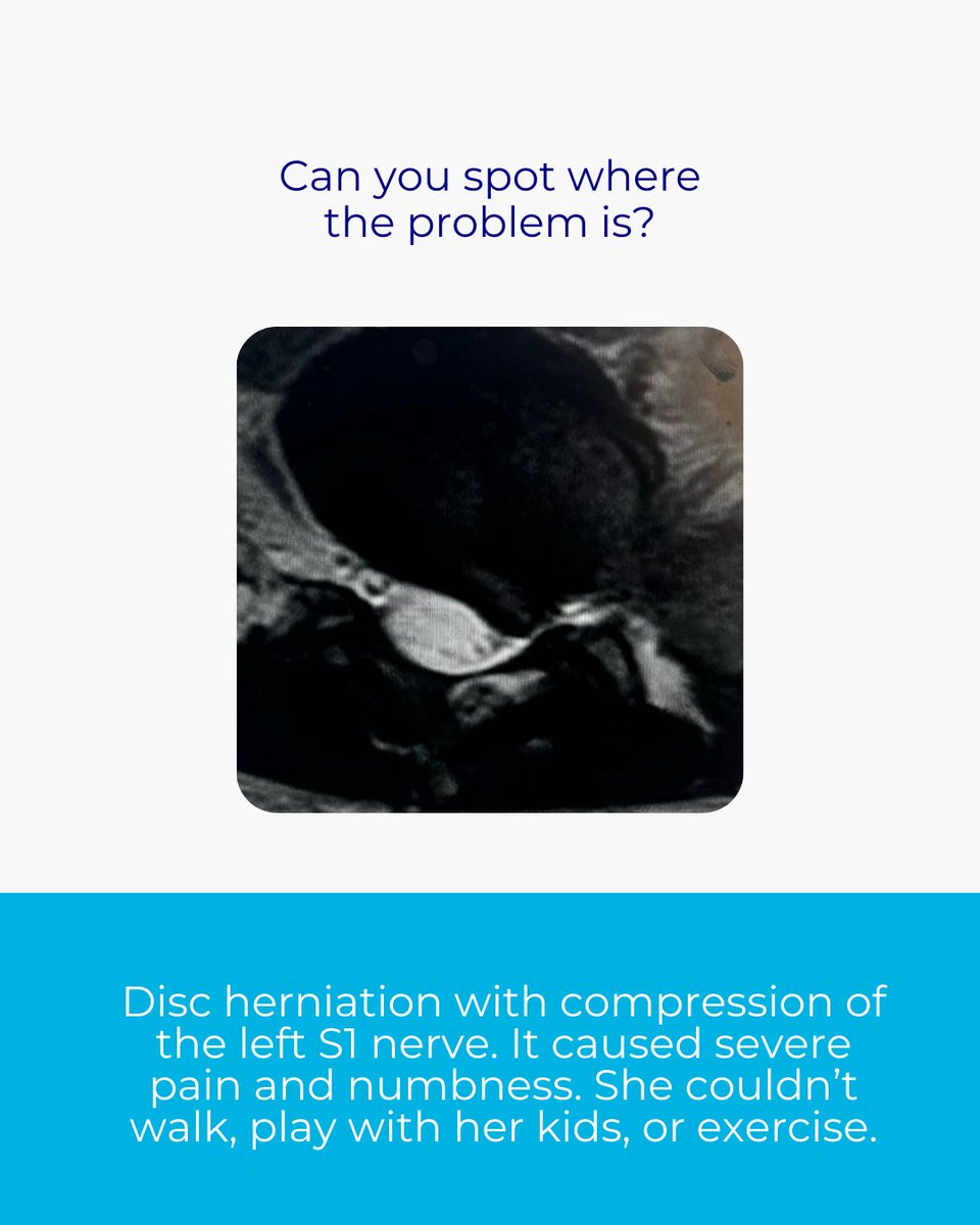 JDchiro's tweet image. They told her she needed surgery.
But the real problem was pressure on the nerve.

Once that pressure was reduced, the pain disappeared and she got her life back.

Sometimes it is not about more treatments
it is about treating the right problem.

#backpain #sciatica