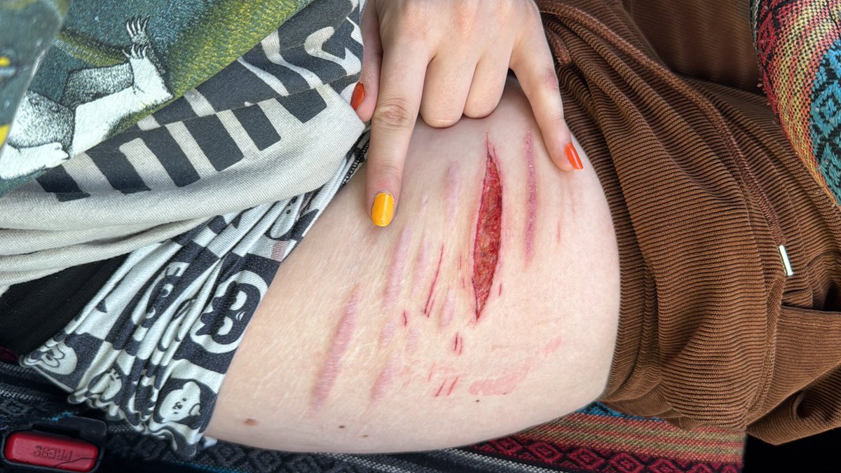 I go to fill empty space between scars and it makes more space 
When will I ever be free T^T
#shtwt 
TW: Healing Beans