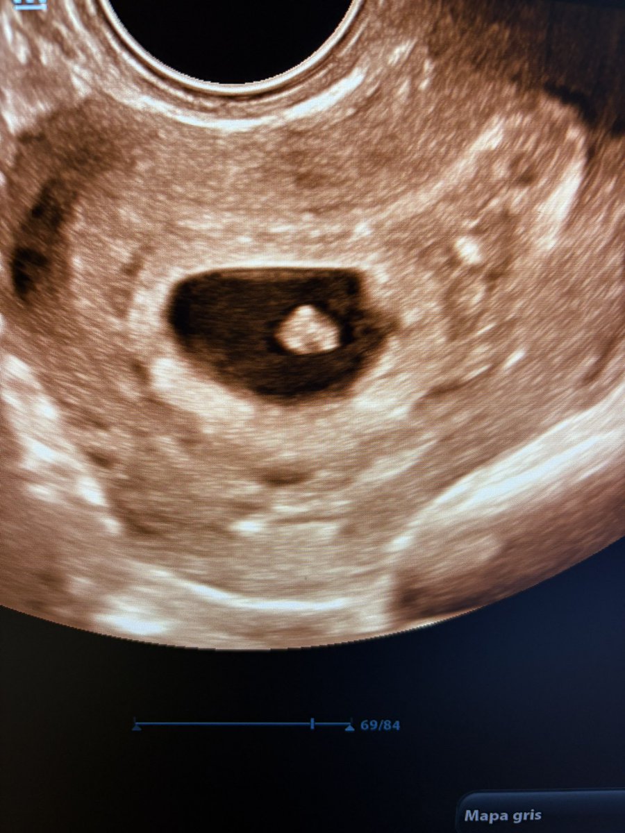 “Llevo 5 años sin contracepción; yo medía todos los años la hormona antimulleriana y estaba bajita. Cada vez bajaba más, y el último control estaba en 0,37”. 

Acá está el 0,37 con latido 💗. 

Para una mujer de 39 años, sin hijos, es una noticia que cambia la vida, para bien.