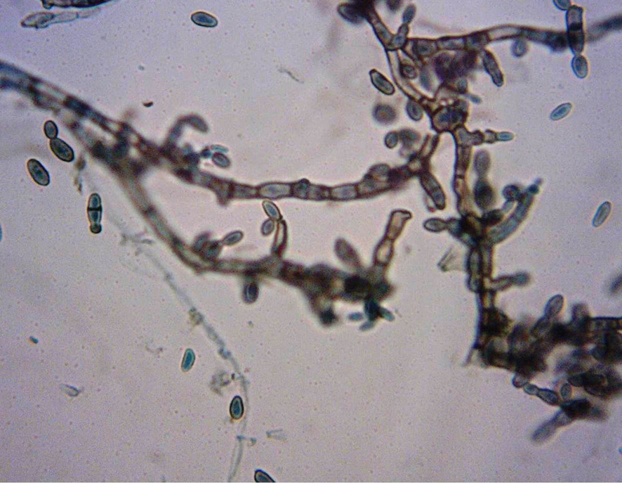 guerreroespejo's tweet photo. The exam revealed septate, dematiaceous hyphae, &amp; presence of yeast-like cells with spores.
🧫in Sabouraud's agar: a moist, shiny, rough, &amp; black colony, identified as Hortaea werneckii.

TINEA NIGRA WITH A SPECKLED PATTERN

KEY: The “salt and pepper” aspect
2/3
#IDpost #micology https://t.co/X3z6TGoEIy