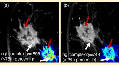 Radiology_AI's tweet image. AI model demonstrates that decreases in certain DCE MRI vascular textures patients with HR2-negative breast cancer predict pCR  doi.org/10.1148/ryai.2…  #BreastCancer #MRI #AI
