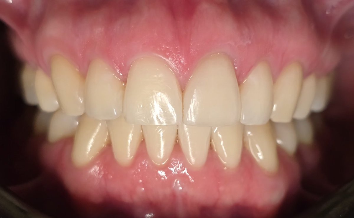 ClaraMarisol7's tweet image. #ortho
#Brackets 
Ese día me sonrió 😉