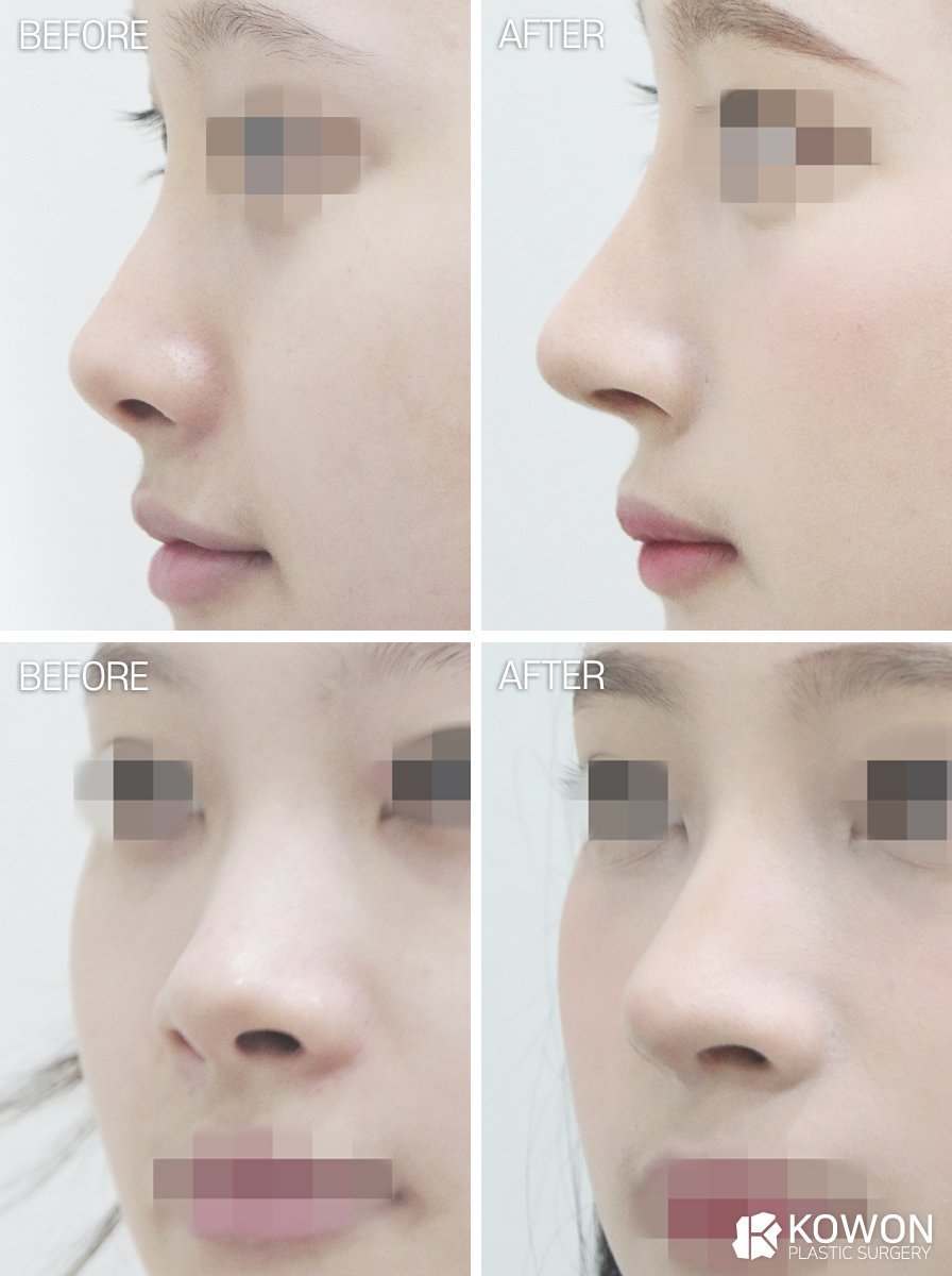 Dr.KimHT (コウォン整形外科) tweet media