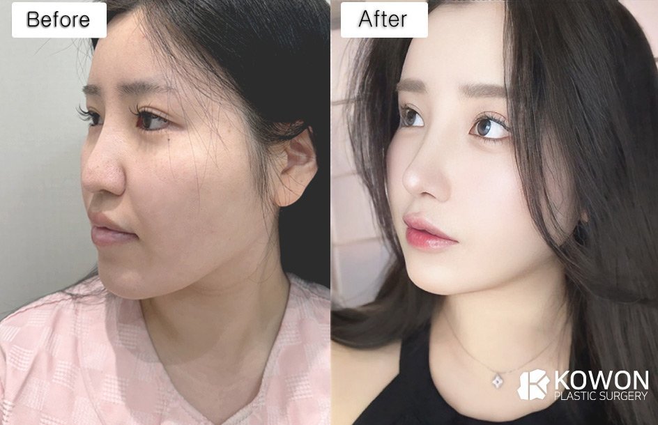 Dr.KimHT (コウォン整形外科) tweet media