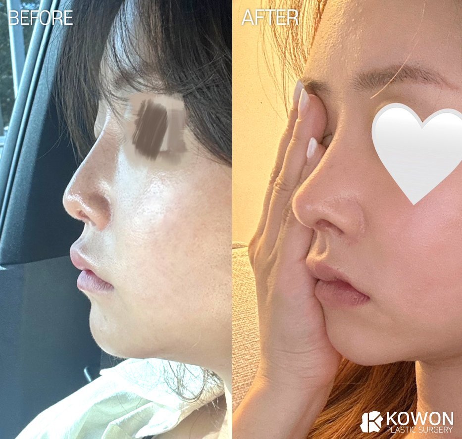 Dr.KimHT (コウォン整形外科) tweet media