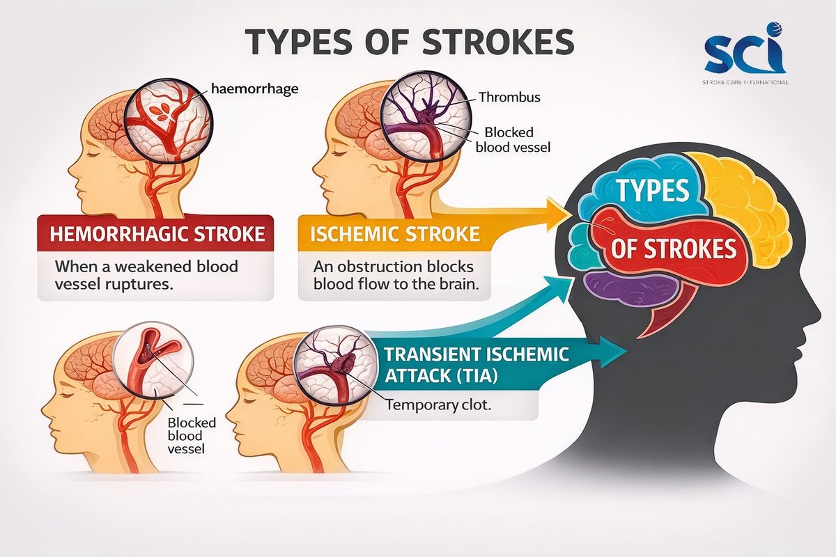 strokecare1's tweet photo. Understand the difference and Save a life.

Not all strokes are the same, some are caused by blocked blood flow, others by bleeding, and some are warning signs you should never ignore.

Stay informed. Act FAST. Every second counts.

#StrokeAwareness  #strokecareinternational https://t.co/2EMEAnpIRC