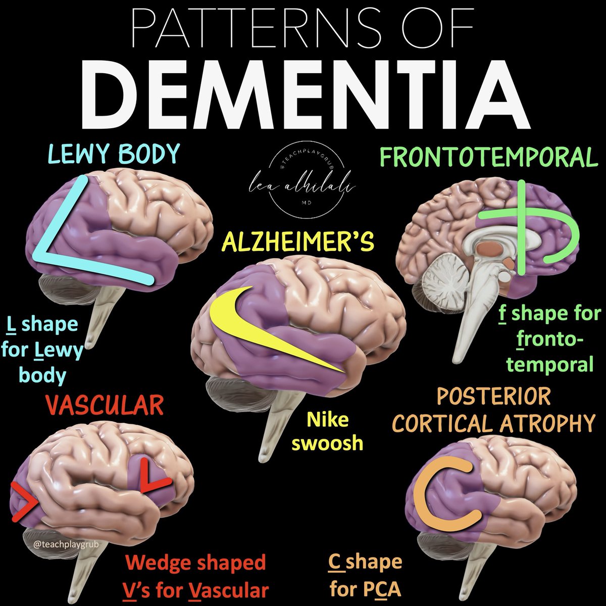 teachplaygrub's tweet photo. Having some mild cognitive impairment trying to remember dementia patterns on imaging?
 
Is looking at dementia PET scans one of your PET peeves?
 
Have short-term memory loss when you read about dementia imaging?
 
Here’s a way to remember dementia patterns so you will never forget!
 
Major dementia imaging patterns:
 
Alzheimer’s disease (AD)
🔸AD has a Nike swoosh pattern—w/decreased metabolism in parietal & temporal regions
🔸Remember if you see a Nike swoosh, just call it!
 
Dementia w/Lewy Bodies (DLB) 
🔸Temporoparietal hypometabolism like AD but also occipital cortex, specific for DLB. DLB also extends farther to the ant. temporal cortex.
🔸Remember, regions of hypometabolism look more like an L. Lewy starts w/an L
 
Frontotemporal Dementia (FTD)
🔸Frontal & temporal hypometabolism as expected, but extends along anterior cingulate gyrus
🔸Anterior cingulate involvement makes hypometabolism looks like a lowercase letter f—& frontotemporal starts w/f
 
Posterior cerebral atrophy
🔸Can be from AD or DLB & has hypometabolism in the occipital & post. temporal lobe, sparing ant temporal lobe
🔸Sparing the ant temporal lobe makes the involvement look like a C instead of an L like DLB. 
So remember pCa
 
Vascular dementia
🔸Vascular dementia is variable, depending on the regions infarcted (V is both for Vascular & Variable)
🔸Wedged shaped regions of hypometabolism corresponding to cortical infarcts—looks like an inverted V
 
This list isn’t all inclusive & there can be variations or even mixed dementias
 
But hopefully this gives you a starting point you won’t soon forget!