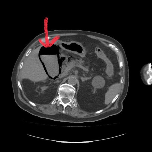 DrAyubaD's tweet image. EMERGENCY 🆘 🆘🆘🆘🆘🆘🆘🆘🆘

SEVERE RIGHT UPPER QUADRANT PAIN + PATIENT IS TOXIC.

What has happened to the Gallbladder shown by the RED ARROW?
#Radres #Radiology #MedTwitter