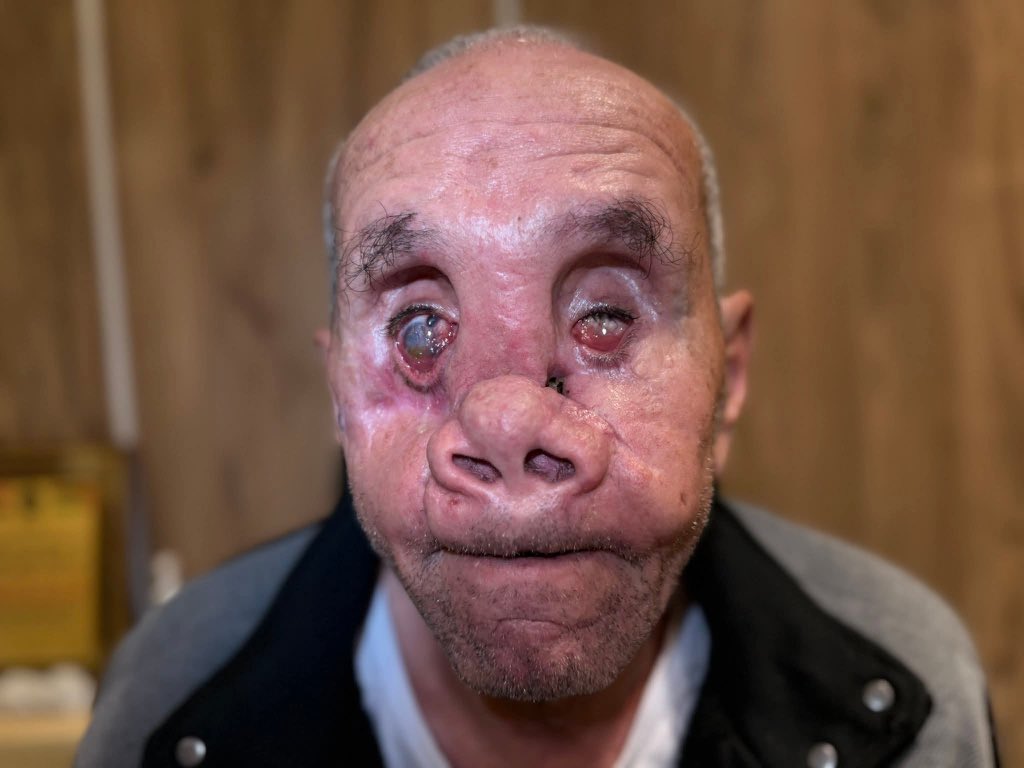 Dine by Israeli occupation.. This is one of the Gaza genocide faces.. 

This man left Gaza yesterday heading to Egypt for potential plastic surgery wishing to help repairing the appearance of his face..