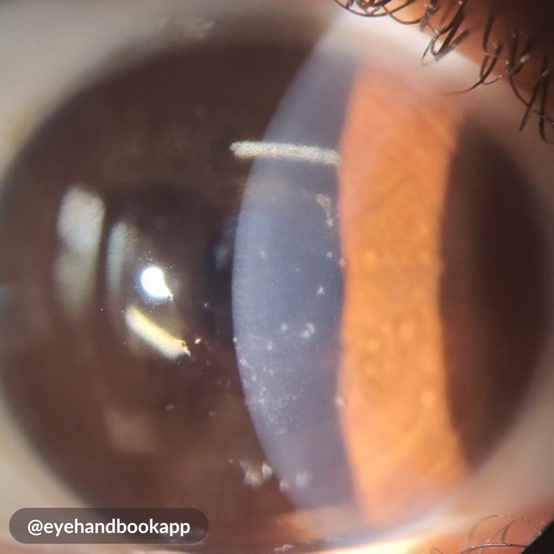 EyeHandbook's tweet photo. How will you manage this case?
#eyes #cornea #clinicalcalculators #eyecalculators #eyeatlas #ophthalmologist #optometrist #eyedoctors #ophthalmology #optometry #cornea #ophthalmologyresident #retina #optometryresident #ophthalmologyapp #oftalmologia #eyesight #vision #slitlamp https://t.co/nDzElZWSdb