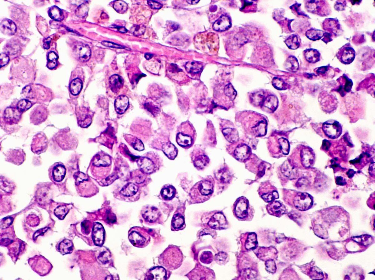 #PathQuiz 🔬

A) Alveolar Rhabdomyosarcoma
B) Proximal Epithelioid Sarcoma
C) Clear cell sarcoma
D) Extrarenal Rhabdoid Tumor

#Pathology #SoftTissuePath 
#PediPath👶 Clue in caption 🧐