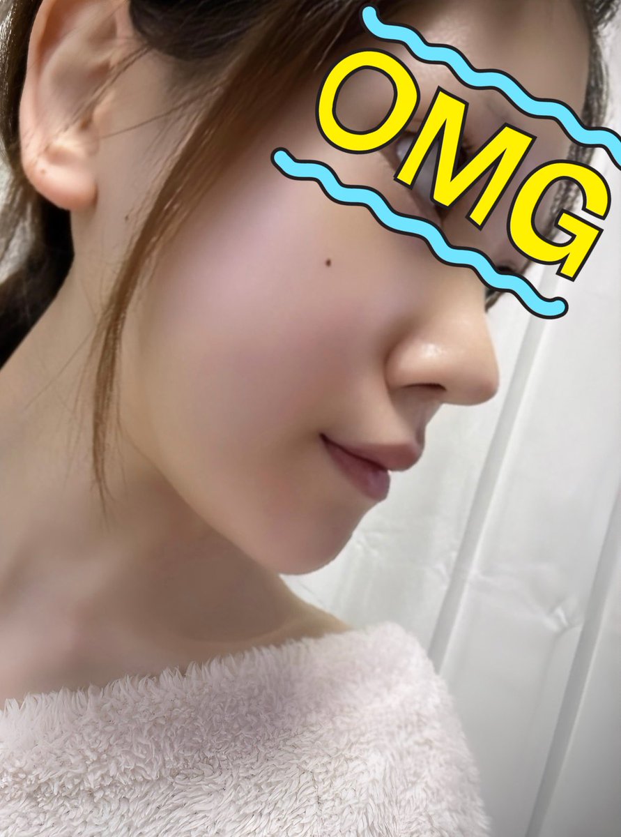 🩶 輪郭3点＋鼻フル(再)、額挙上、自然癒着目つき矯正dt tweet media