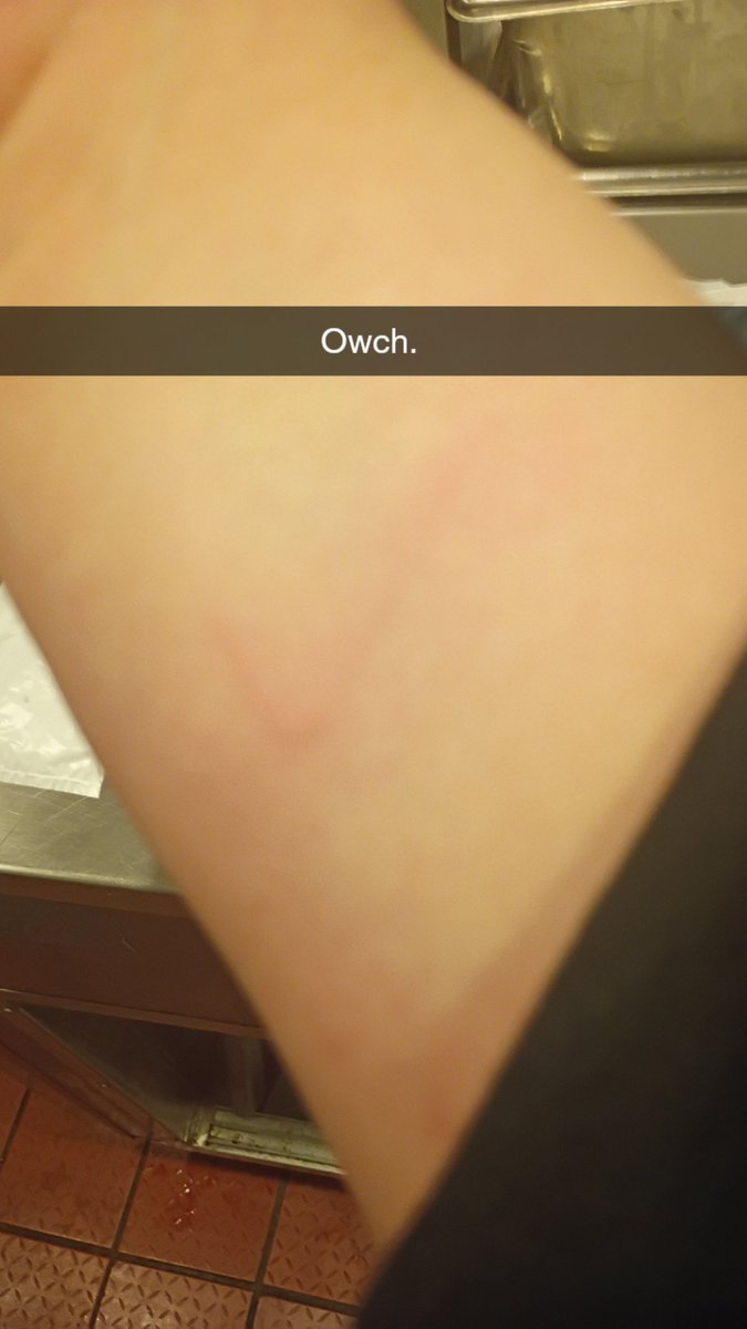 L shaped burn :(. I am loser 🫪