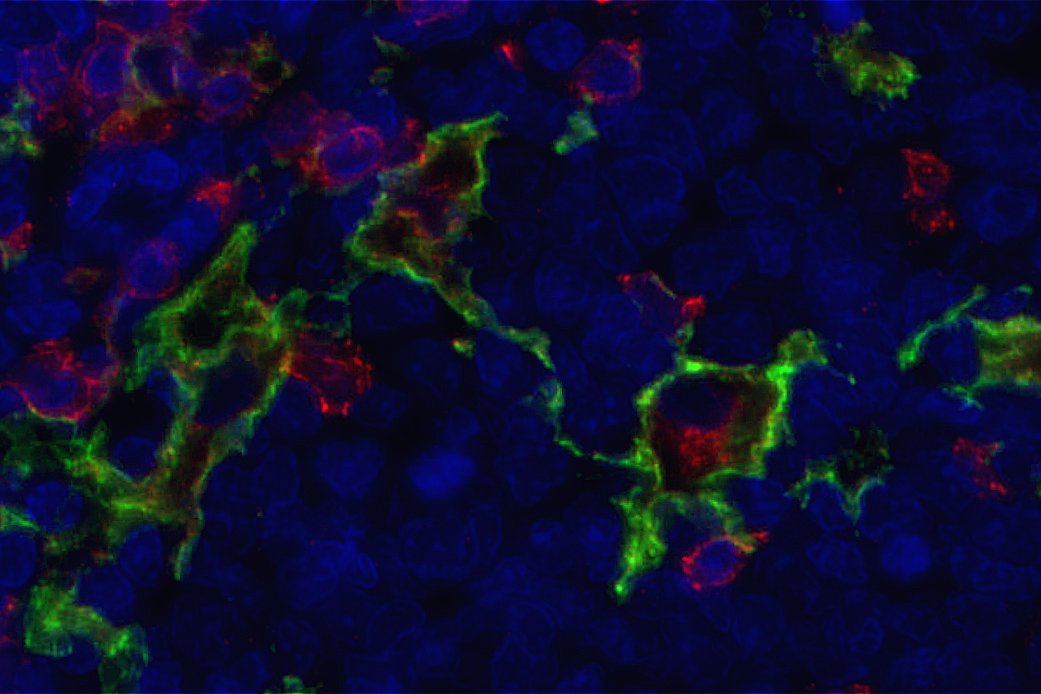 OffspringBioAB's tweet photo. Meet the sentinel of the immune system.

This is a CD4+CD11c+ dendritic cell in healthy human tonsil, extending its long, elegant arms to constantly survey its environment for threats. Beauty of structure meeting function.

#Immunology #DendriticCell #Microscopy #ScienceAsArt https://t.co/Hg2aF7D5om