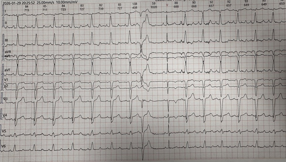K_Letsas's tweet photo. The “peeling back” effect of a PVC: the functional block can be resolved, given that the conduction is facilitated temporarily owing to the peeling back of the refractory period.
#epeeps #ecg https://t.co/e95GBF5YQP
