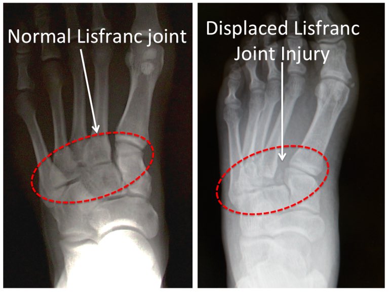 إصابات Lisfranc ligament او الكسور حولها و هو ما يعرف بالرباط الواصل بين مشط القدم الاول و الثاني في منتصف القدم 

التشخيص المبكر يصنع الفارق الحقيقي ، فالتأخير في التشخيص قد يؤدي إلى انهيار القوس الطولي للقدم وألم مزمن و خشونة مبكرة يصعب علاجه لاحقًا 

#قدم #كسر #جراحة #طبيب