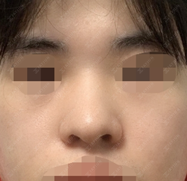 jayjun_jpn_BA's tweet image. 【#JAYJUN 韓国整形】鼻整形の1か月目 #症例写真

鼻整形(鼻筋+鼻先)・骨切幅寄せ・矢印鼻・鼻中隔軟骨・耳介軟骨・プロテーゼ

正面のバランスを整え、鼻先まで繊細に、シャープで洗練された印象へ✨

💙LINE相談：@jayjunjp
💭 lin.ee/PCuzUuj

#小鼻縮小 #整形レポ #渡韓整形 #メンズ美容