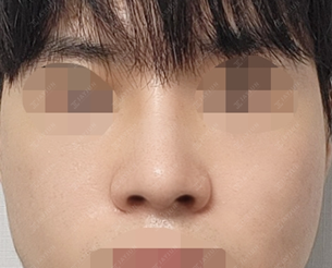 jayjun_jpn_BA's tweet image. 【#JAYJUN 韓国整形】鼻整形の1か月目 #症例写真

鼻整形(鼻筋+鼻先)・骨切幅寄せ・矢印鼻・鼻中隔軟骨・耳介軟骨・プロテーゼ

正面のバランスを整え、鼻先まで繊細に、シャープで洗練された印象へ✨

💙LINE相談：@jayjunjp
💭 lin.ee/PCuzUuj

#小鼻縮小 #整形レポ #渡韓整形 #メンズ美容