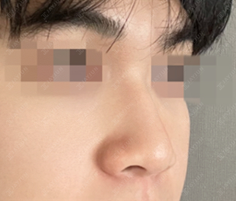 jayjun_jpn_BA's tweet image. ✨JAYJUN美容外科✨

【#JAYJUN 症例写真】鼻整形(鼻筋+鼻先)
わし鼻・曲がり鼻矯正・骨切幅寄せ・団子鼻修正・寄贈肋軟骨・鼻中隔軟骨・プロテーゼ

🦴骨切り幅寄せで土台から整え
🧱鼻筋・鼻先の支持構造を強化
🧬歪み＋軟部組織のボリュームを同時に調整

#渡韓整形 #メンズ美容 #鼻修正 #鼻フル