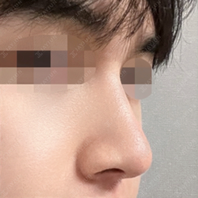 jayjun_jpn_BA's tweet image. ✨JAYJUN美容外科✨

【#JAYJUN 症例写真】鼻整形(鼻筋+鼻先)
わし鼻・曲がり鼻矯正・骨切幅寄せ・団子鼻修正・寄贈肋軟骨・鼻中隔軟骨・プロテーゼ

🦴骨切り幅寄せで土台から整え
🧱鼻筋・鼻先の支持構造を強化
🧬歪み＋軟部組織のボリュームを同時に調整

#渡韓整形 #メンズ美容 #鼻修正 #鼻フル