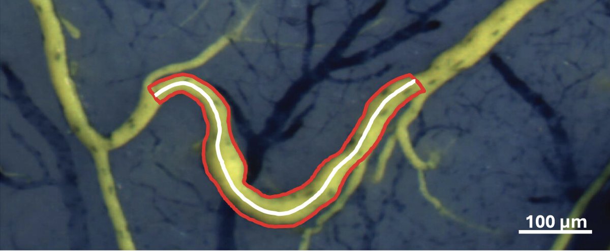 _JCBFM's tweet image. 🚨 Old drug, new life-saving potential in stroke

#HotTopic: Repurposing the FDA-approved cilostazol to boost collateral blood flow 🧠

A promising strategy for acute stroke treatment?
🔗 journals.sagepub.com/doi/full/10.11…

#Stroke #Neuroscience #TranslationalResearch