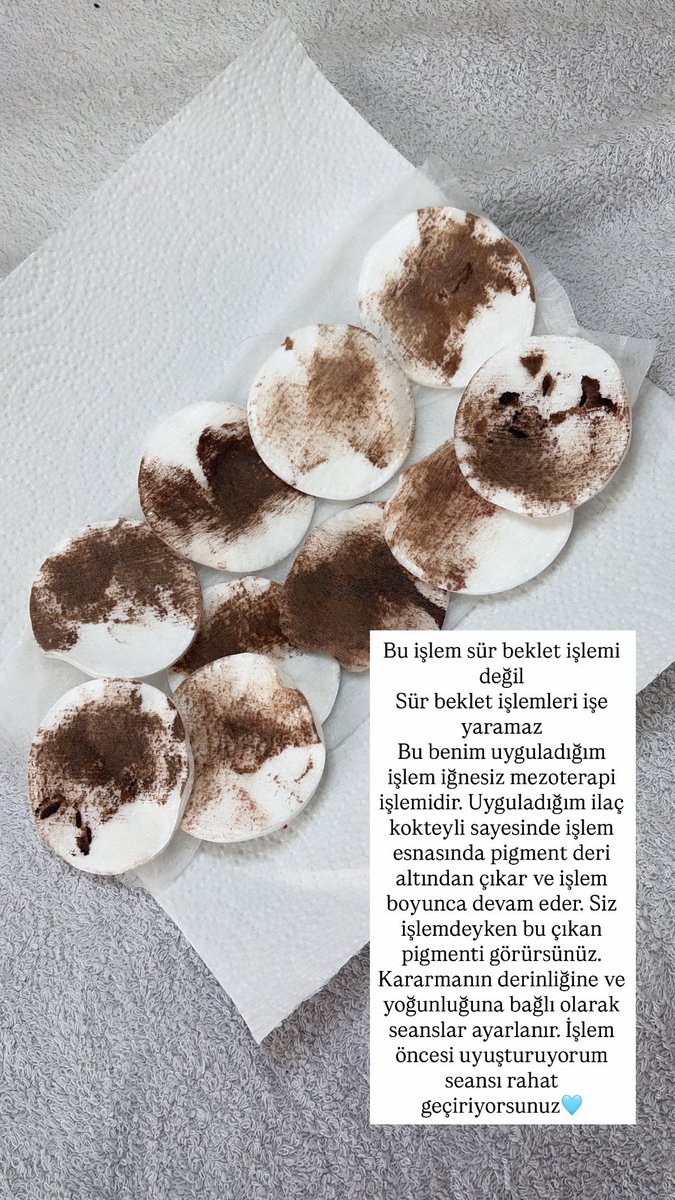 ElifTrtk's tweet photo. @usersrl0609 @Drkdmr01 Mikro iğnelerle çalıştığım işlem ile ve ilaç kokteyli ile, seansın 10-15. Dakikasında deri altındaki pigment parçalanıp deri yüzeyine çıkıyor ve bunu seans esnasında sizde görüyorsunuz, acısız bir işlemdir https://t.co/4yaekqnKBk